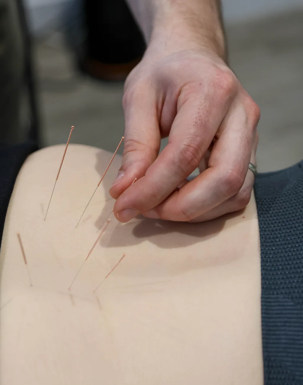 Medical acupuncture applied to the lower back at BetterMe Physiotherapy